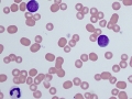 Acute myeloid leukemia (AML)