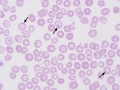 Vitamin B6 deficiency