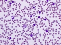 CLL (DQ)