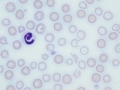 Iron deficiency (after transfusion)