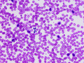 Chronic lymphocytic leukemia of granular lymphocytes (GL-CLL)