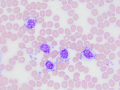 GL-CLL (Wright's)
