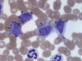 Leukemia of granular lymphocytes