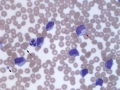 Leukemia of granular lymphocytes