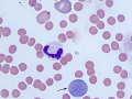 Macroplatelet & spherocytes