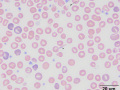 Hemoglobin crystal