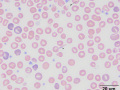 Hemoglobin crystal