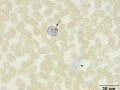 "Gray" eosinophil & neutrophil (SBB)