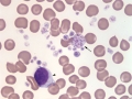Platelet clump