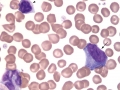 Reactive lymphocyte