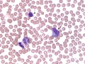 Reactive lymphocyte