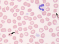 Acanthocytes