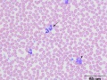 "Gray" eosinophils