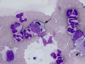 Bile cast & histiocyte