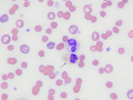 Bilirubin crystals