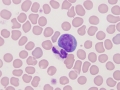 Neutrophil & reactive lymphocyte