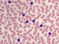CLL