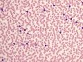 CLL