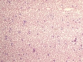 Chronic lymphocytic leukemia (CLL)