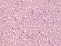 Eosinophilia & lymphocytosis