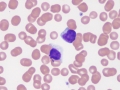 Granular and reactive lymphocytes