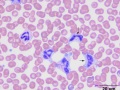 "Gray" eosinophils