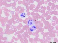 "Gray" eosinophil