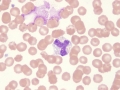 "Gray" eosinophil