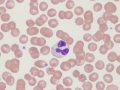 "Gray" eosinophil