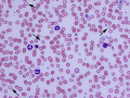 Iron deficiency