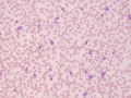 Leukocytosis