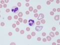 Band and segmented neutrophils