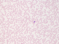 Pancytopenia