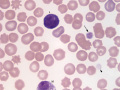 Acanthocytes & reactive lymphocyte