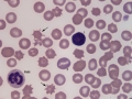 Acanthocytes & WBC
