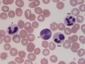 Acanthocytes & left shift