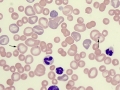 IMHA (siderocytes)