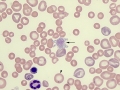 IMHA (siderocytes)
