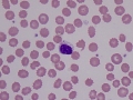 Storage disease