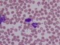 Storage disease