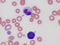 Toxic band & reactive lymphocyte