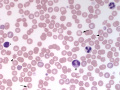 Acanthocytes & WBC