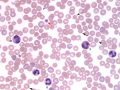 Acanthocytes & WBC (hemangiosarcoma)