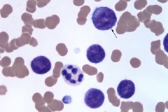 Chronic leukemia