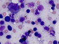 Leukemia of granular lymphocytes (dog)