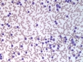 Chronic lymphocytic leukemia (CLL; horse)