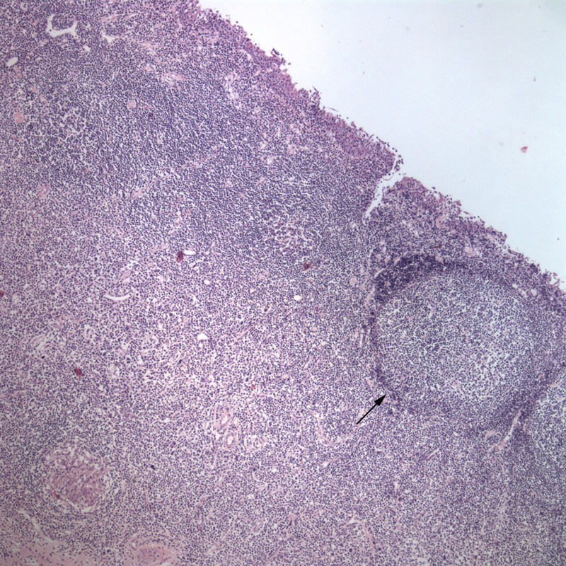Atypical CML (H&E, dog, tonsil)