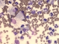 Pleuritis due to carcinoma (cat)