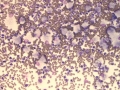 Pleuritis due to carcinoma (cat)