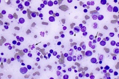Dysplasia